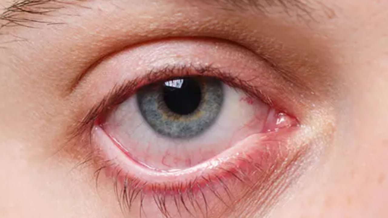 Foto - Sinsice ilerleyen hastalığa dikkat: Kalıcı körlüğe neden oluyor!