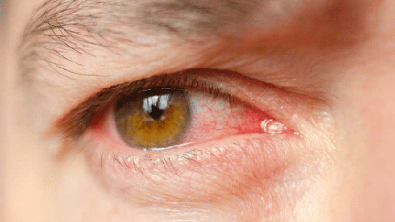 Foto - Sinsice ilerleyen hastalığa dikkat: Kalıcı körlüğe neden oluyor!