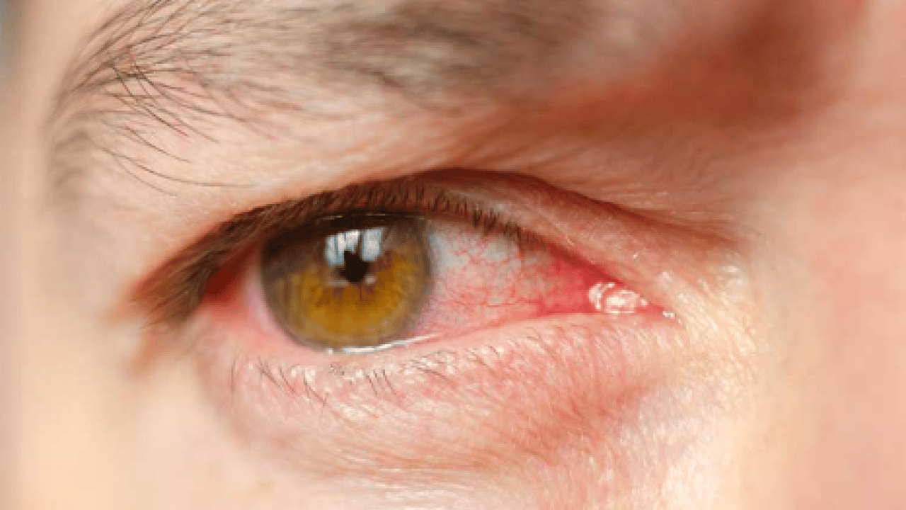 Foto - Sinsice ilerleyen hastalığa dikkat: Kalıcı körlüğe neden oluyor!