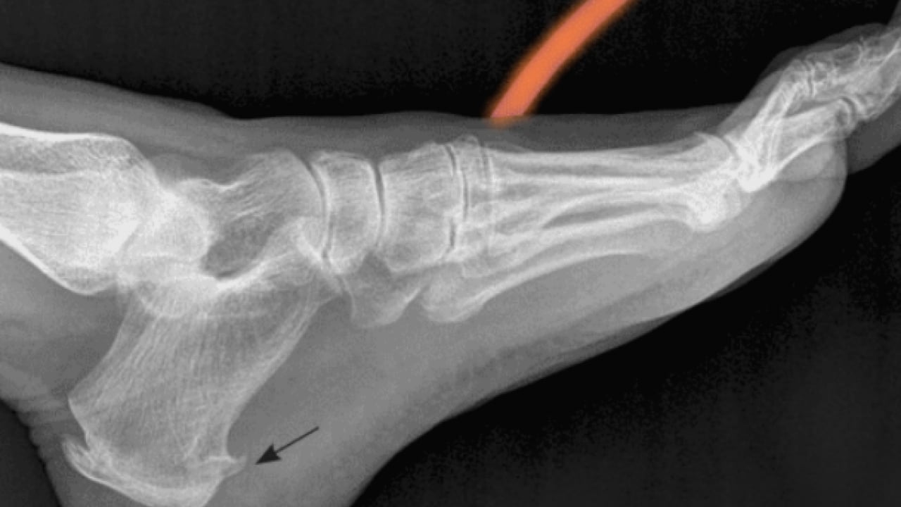 Foto - Hiç hesapta olmayan bu ağrıyı anjiyografik yöntem ile yok edin! Uzmanlar şiddetle tavsiye ediyor...