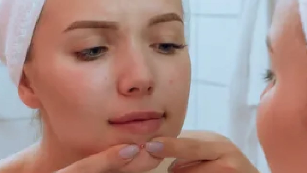 Foto - Hiç hesapta olmayan gelişme olmasın! Bu sivilceleri asla sıkmayın! Masum sanılıyor ama büyük risk