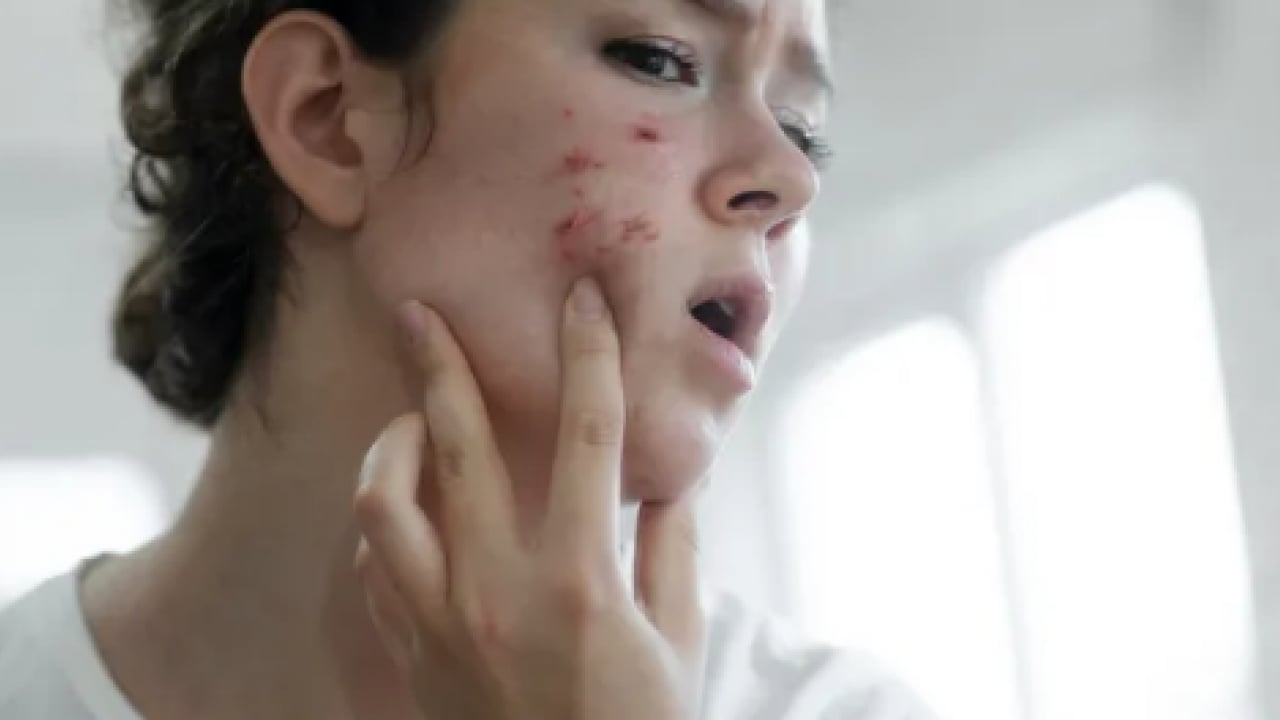 Foto - Hiç hesapta olmayan gelişme olmasın! Bu sivilceleri asla sıkmayın! Masum sanılıyor ama büyük risk