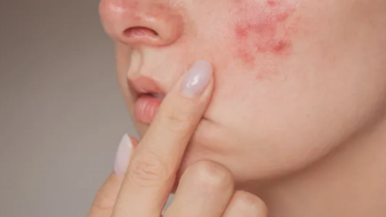 Foto - Hiç hesapta olmayan gelişme olmasın! Bu sivilceleri asla sıkmayın! Masum sanılıyor ama büyük risk