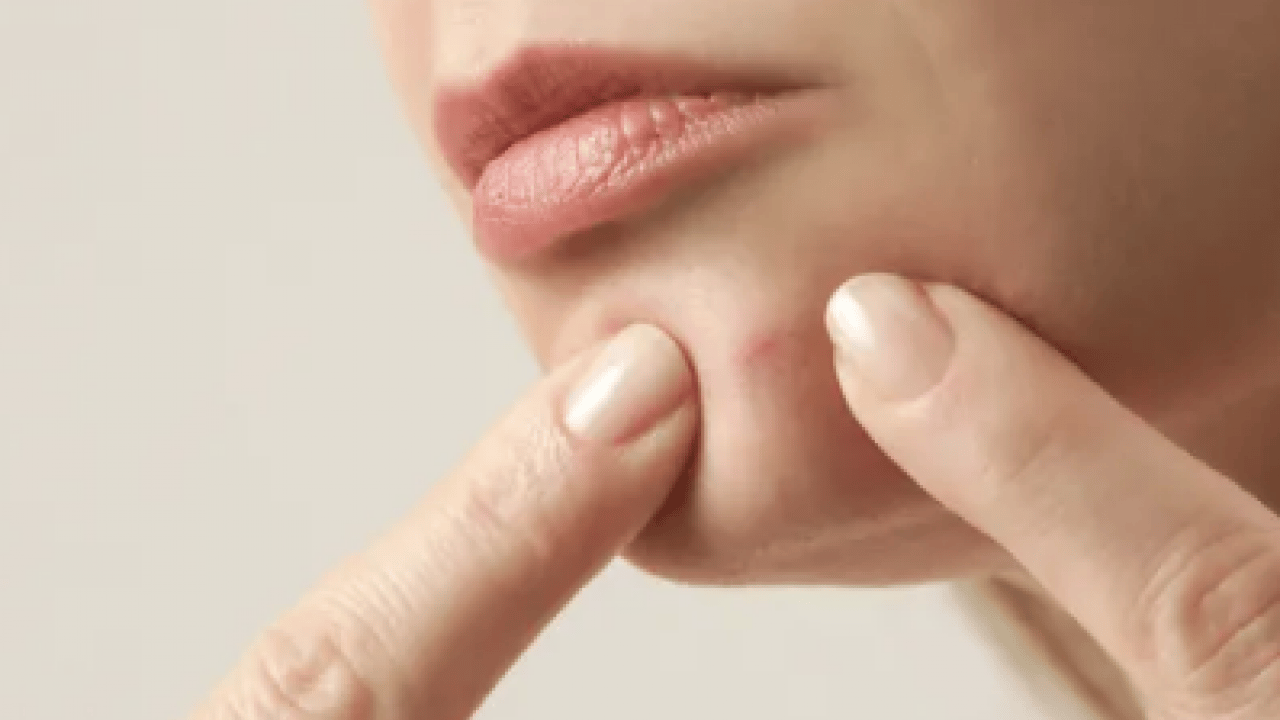 Hiç hesapta olmayan gelişme olmasın! Bu sivilceleri asla sıkmayın! Masum sanılıyor ama büyük risk