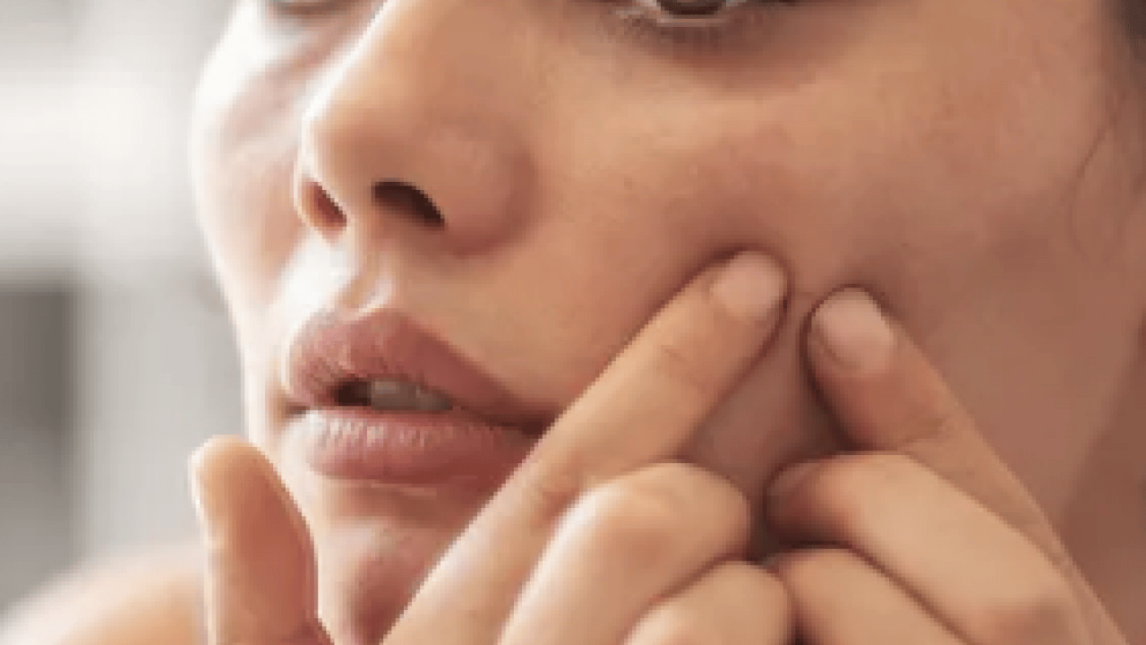 Foto - Hiç hesapta olmayan gelişme olmasın! Bu sivilceleri asla sıkmayın! Masum sanılıyor ama büyük risk