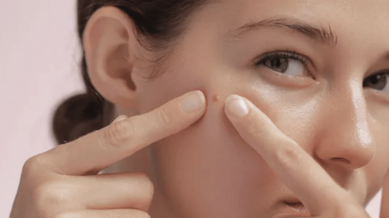 Foto - Hiç hesapta olmayan gelişme olmasın! Bu sivilceleri asla sıkmayın! Masum sanılıyor ama büyük risk