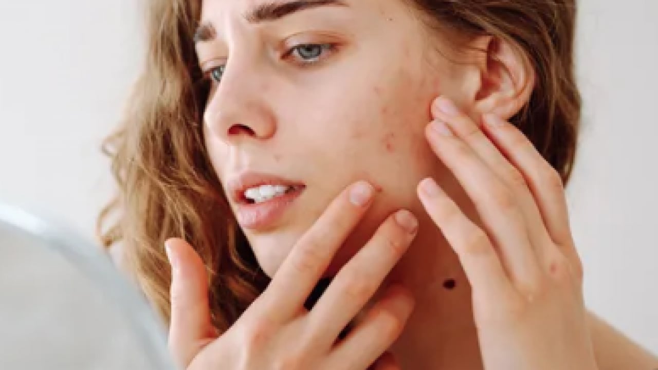 Foto - Hiç hesapta olmayan gelişme olmasın! Bu sivilceleri asla sıkmayın! Masum sanılıyor ama büyük risk