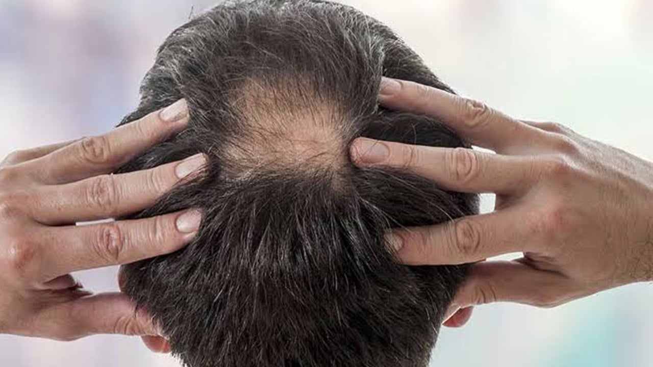 Foto - Hint yağı saç dökülmesini bitiren yağ: Dökülen saçlarınızı ayağa kaldıran yol! Evlerde bunu yapan yaşadı