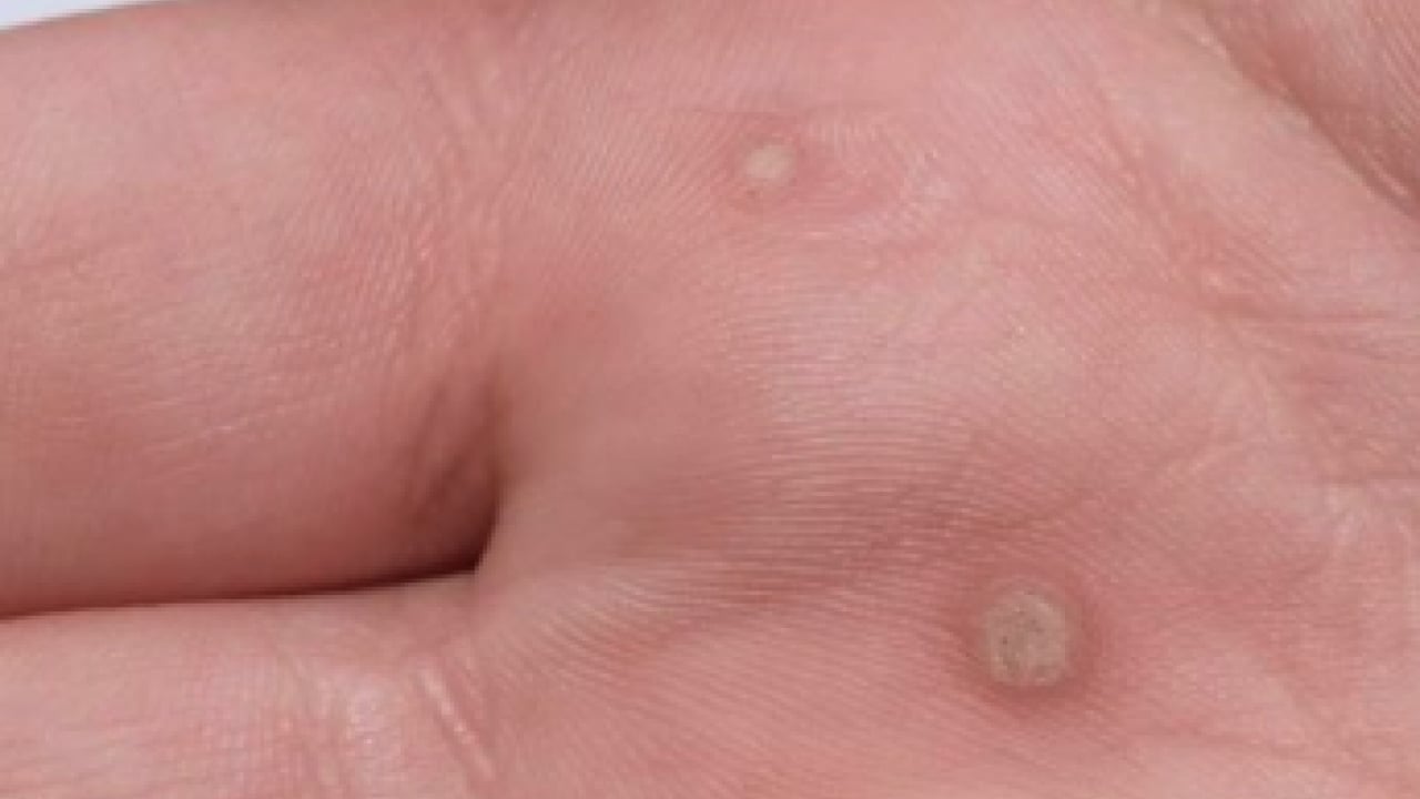 İbn-i Sina'nın siğillere formülü: Ne kurt bırakıyor ne mikrop! Siğillere karşı önerdiği bitki! 