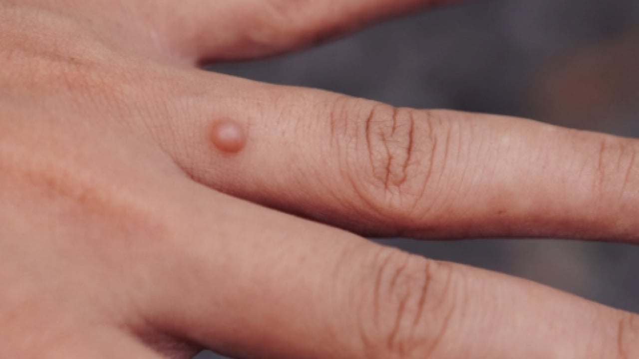 Foto - İbn-i Sina'nın siğillere formülü: Ne kurt bırakıyor ne mikrop! Siğillere karşı önerdiği bitki! 