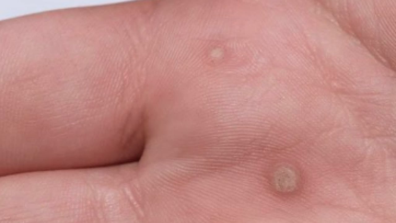 Foto - İbn-i Sina'nın siğillere formülü: Ne kurt bırakıyor ne mikrop! Siğillere karşı önerdiği bitki! 