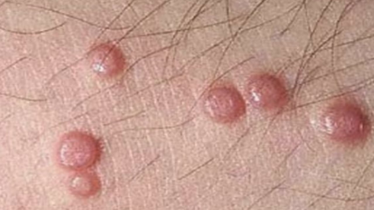 Foto - İbn-i Sina'nın siğillere formülü: Ne kurt bırakıyor ne mikrop! Siğillere karşı önerdiği bitki! 