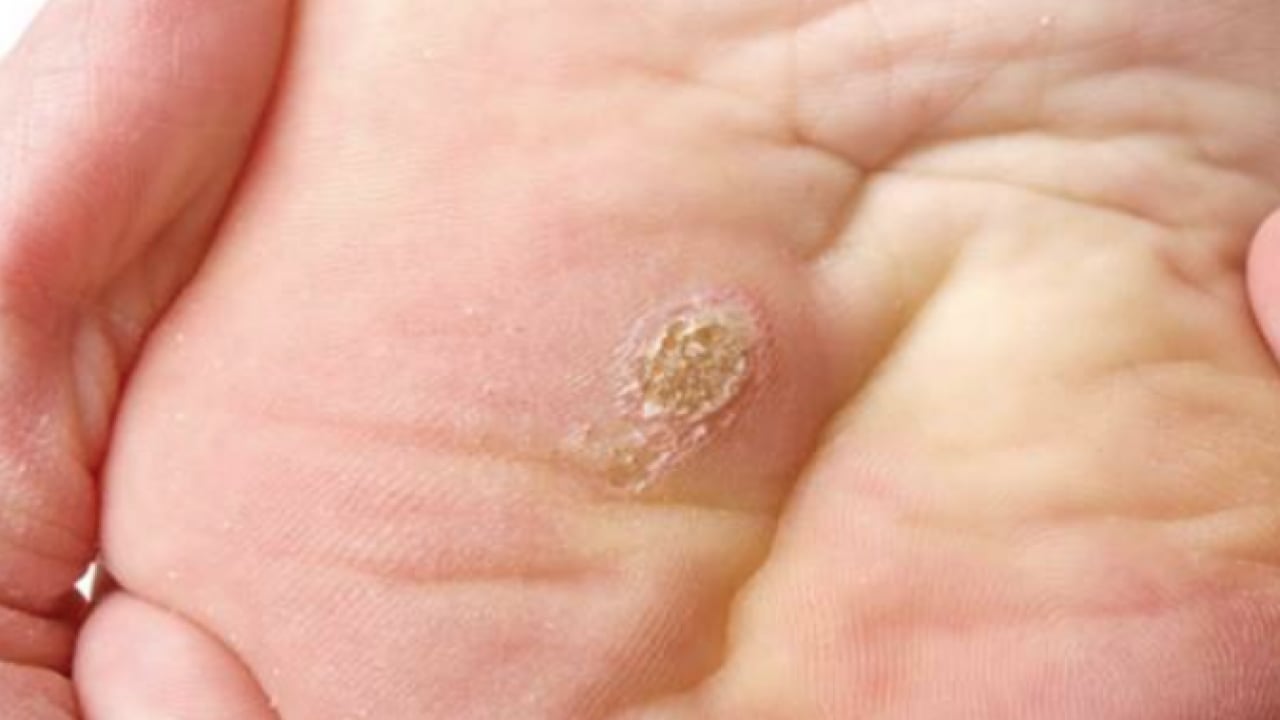 Foto - İbn-i Sina'nın siğillere formülü: Ne kurt bırakıyor ne mikrop! Siğillere karşı önerdiği bitki! 