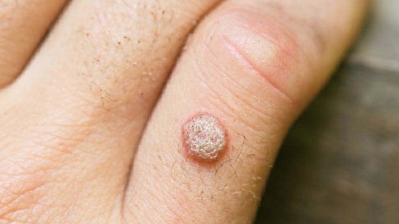 Foto - İbn-i Sina'nın siğillere formülü: Ne kurt bırakıyor ne mikrop! Siğillere karşı önerdiği bitki! 