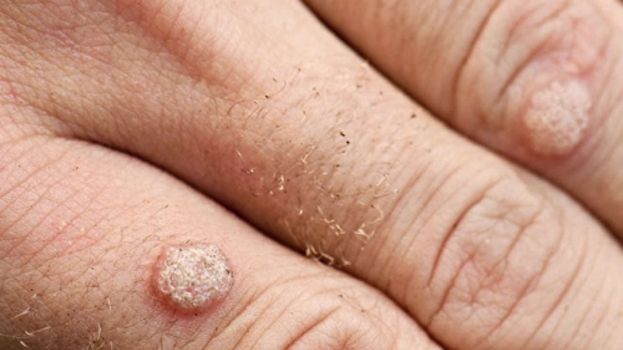 Foto - İbn-i Sina'nın siğillere formülü: Ne kurt bırakıyor ne mikrop! Siğillere karşı önerdiği bitki! 