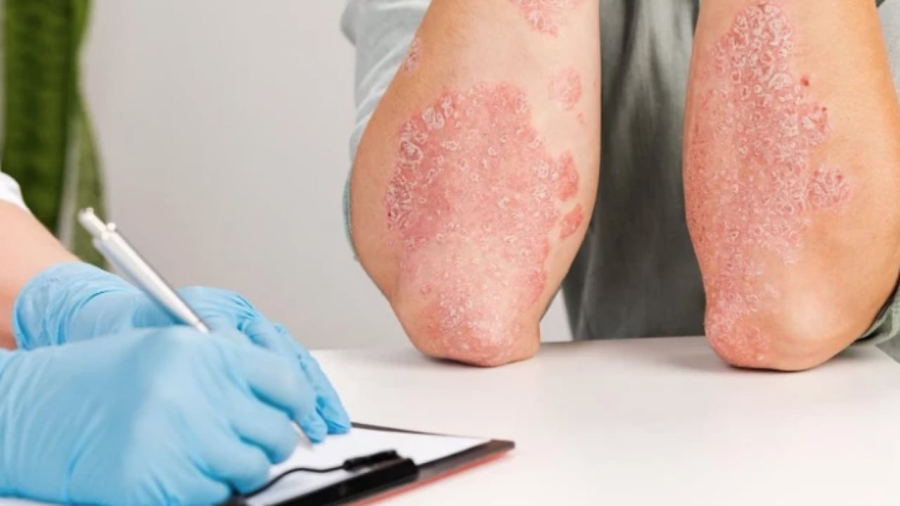 Foto - İbni Sina’nın şifası burada: Asırlık egzama sırrı: Şifalı kısmını çöpe atıyormuşuz! Meğer mucizevi gizli gücü varmış