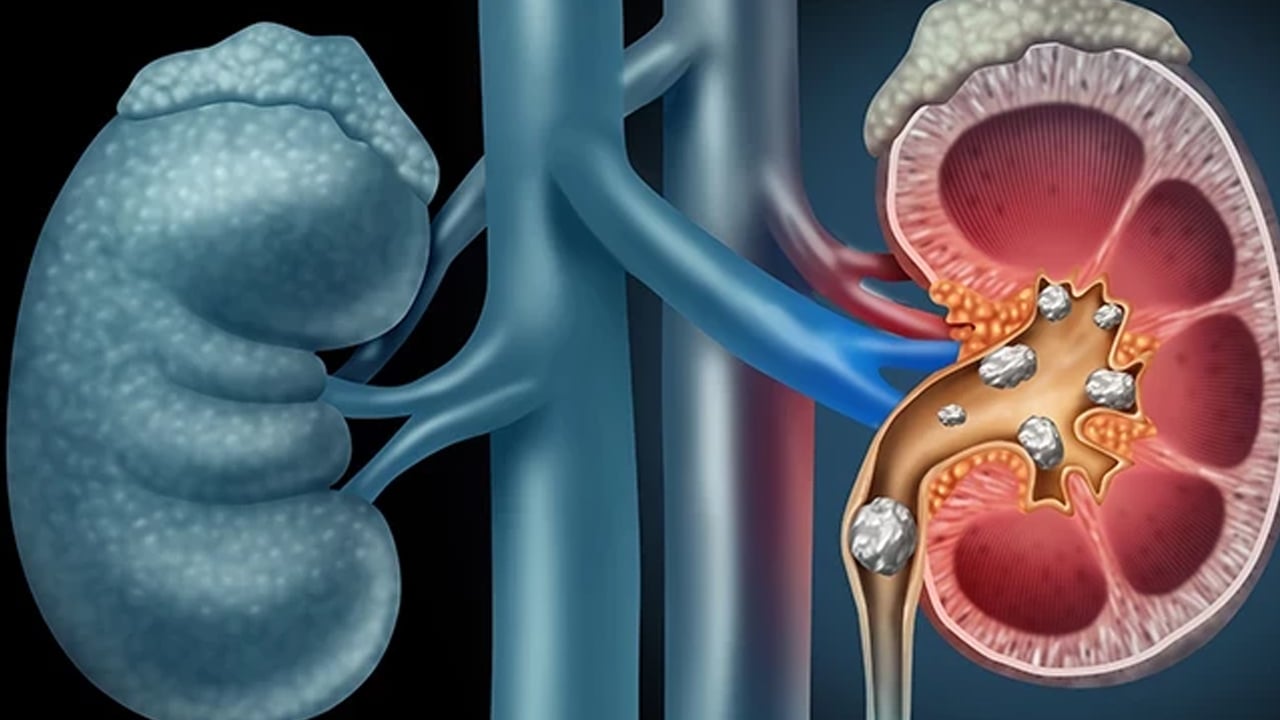 Foto - İbrahim Saraçoğlu öneriyor: Böbreklerin doğal ilacı oymuş! Günde 1 bardak bile içseniz... Bu çözüm tersine çevrilebilir