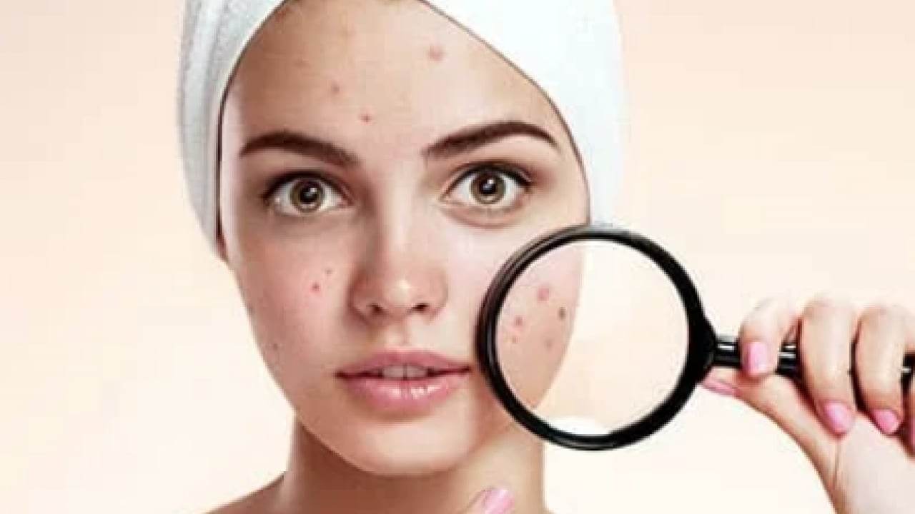 Foto - İltihaplı sivilceyi anında eritip yok ediyor! Asit gibi etkisi var, 1 damlası sivilceyi kurutuyor