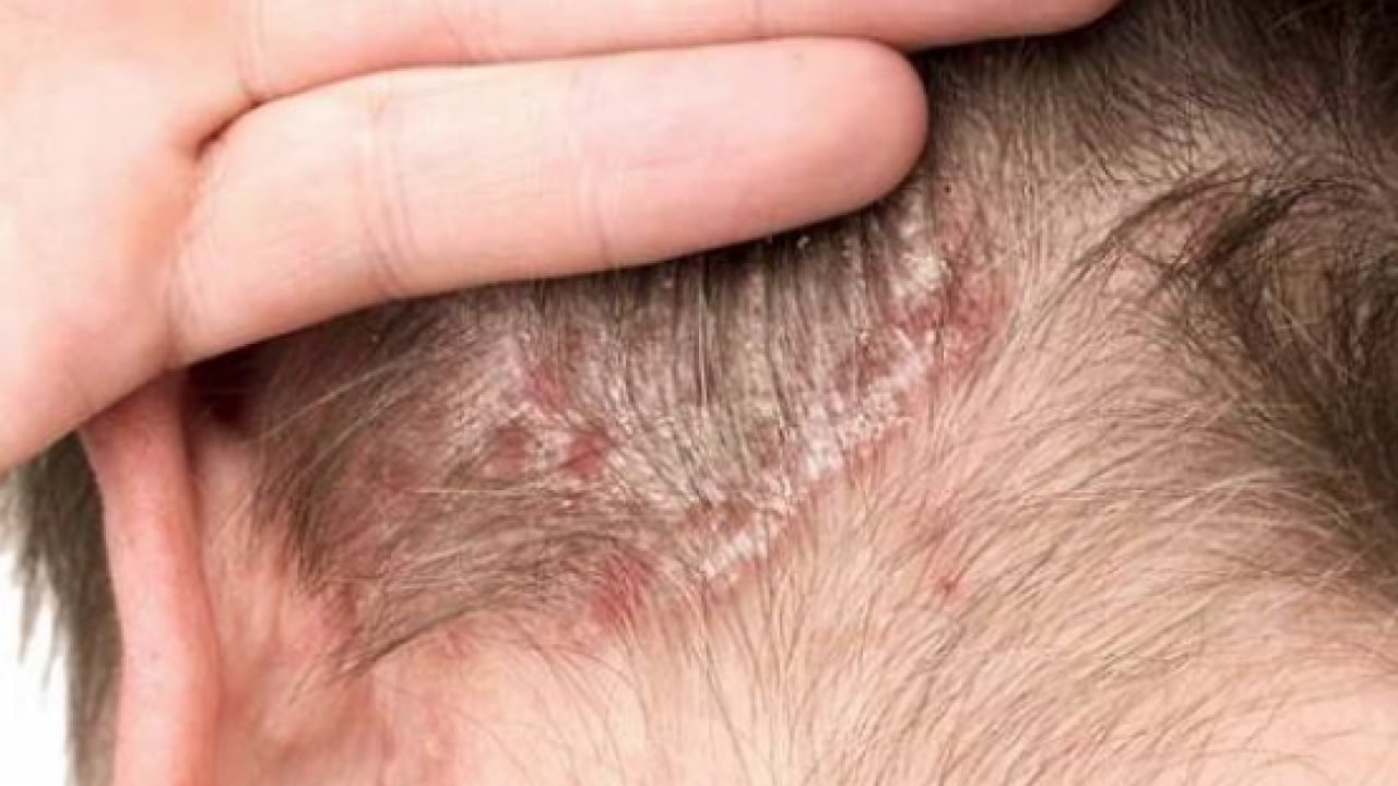 Foto - İltihaplı sivilceyi anında eritip yok ediyor! Asit gibi etkisi var, 1 damlası sivilceyi kurutuyor