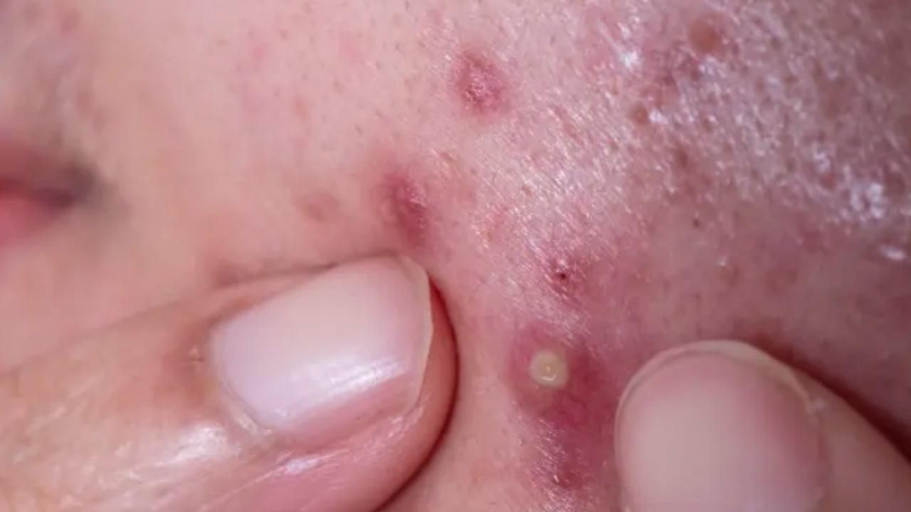 Foto - İltihaplı sivilceyi anında eritip yok ediyor! Asit gibi etkisi var, 1 damlası sivilceyi kurutuyor