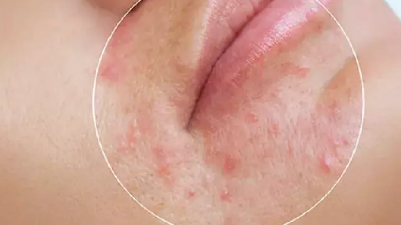 Foto - İltihaplı sivilceyi anında eritip yok ediyor! Asit gibi etkisi var, 1 damlası sivilceyi kurutuyor