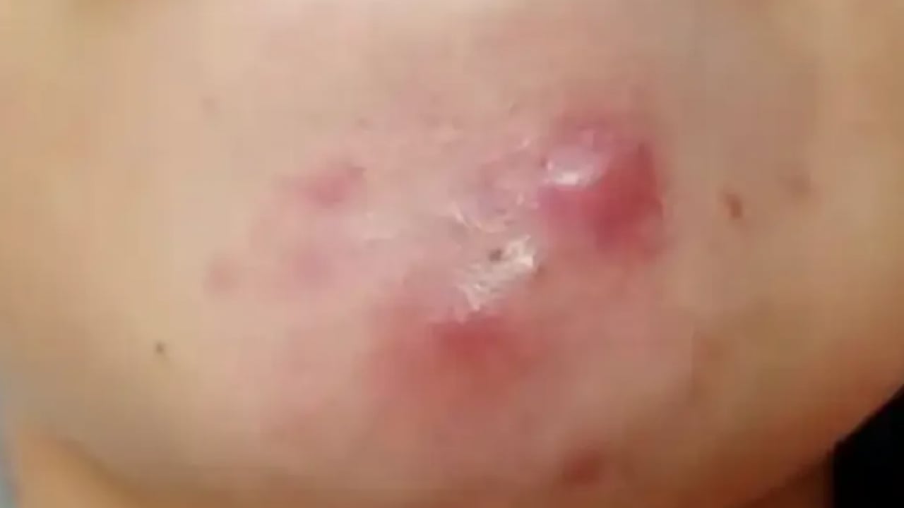 Foto - İltihaplı sivilceyi anında eritip yok ediyor! Asit gibi etkisi var, 1 damlası sivilceyi kurutuyor