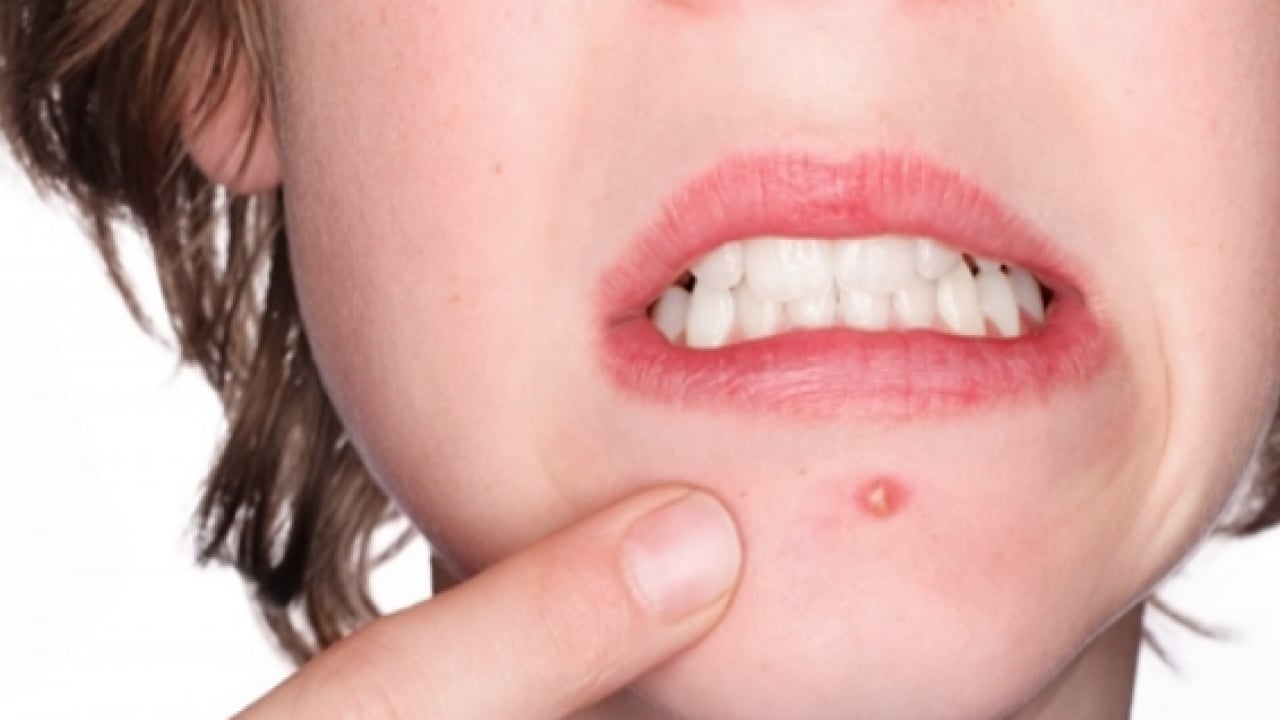 Foto - İltihaplı sivilceyi anında eritip yok ediyor! Asit gibi etkisi var, 1 damlası sivilceyi kurutuyor