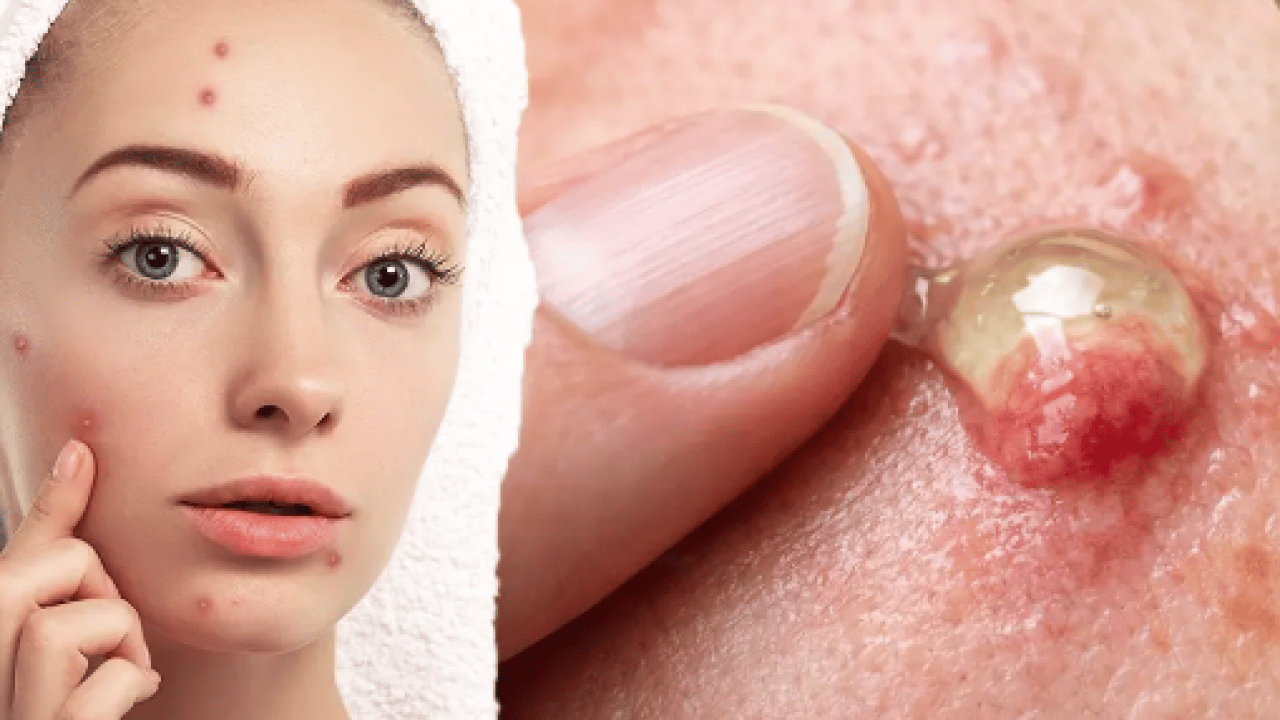 Foto - İltihaplı sivilceyi anında eritip yok ediyor! Asit gibi etkisi var, 1 damlası sivilceyi kurutuyor