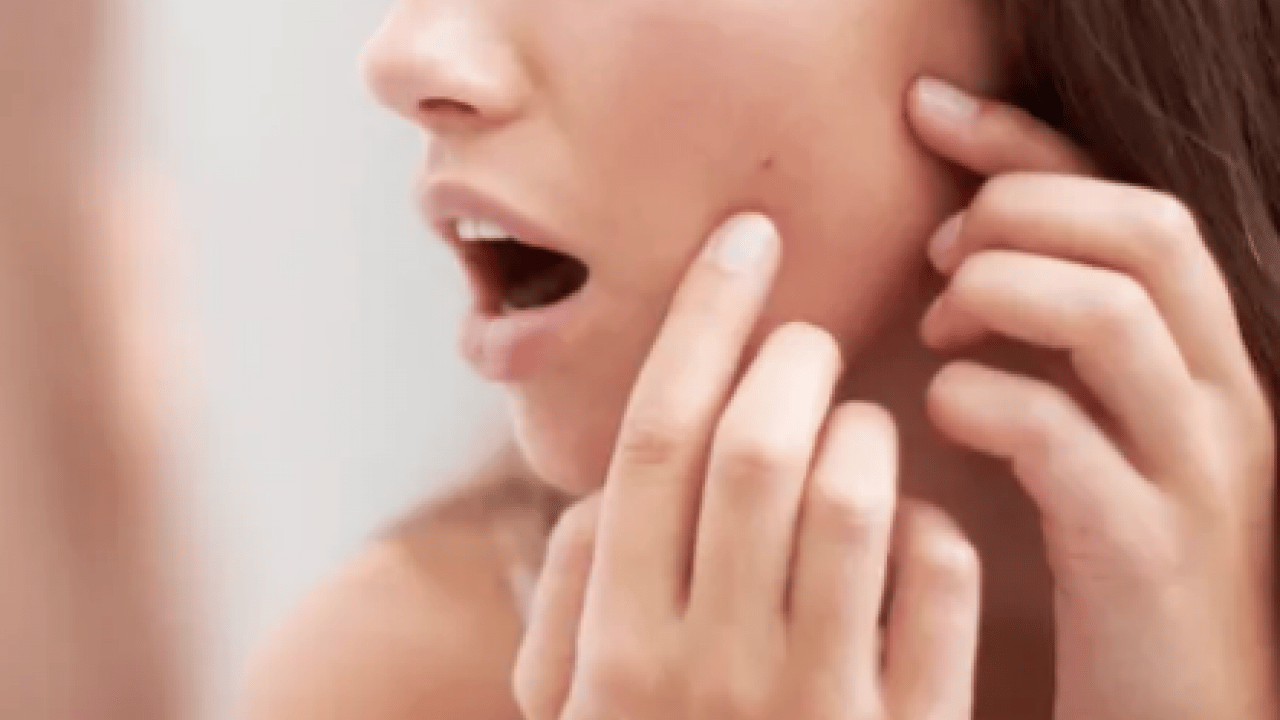 Foto - İltihaplı sivilceyi anında eritip yok ediyor! Asit gibi etkisi var, 1 damlası sivilceyi kurutuyor