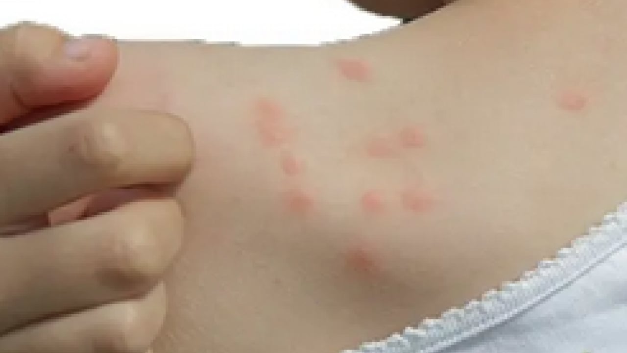 Foto - Isırıklara kolonya dökmeyin! Uzmanı böcek ve pire ısırıklarını ayırt etmek için konuştu...