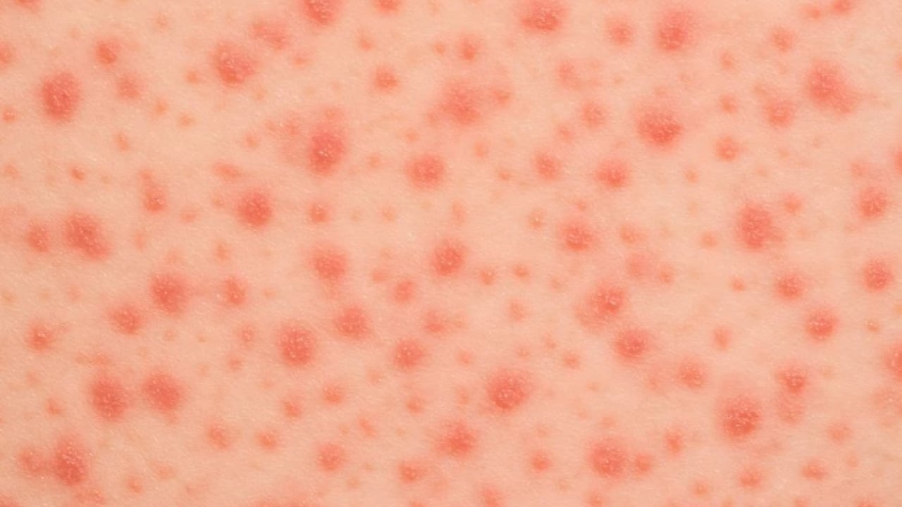 İstanbul’da korkutan salgın! Vakalar hızla artıyor