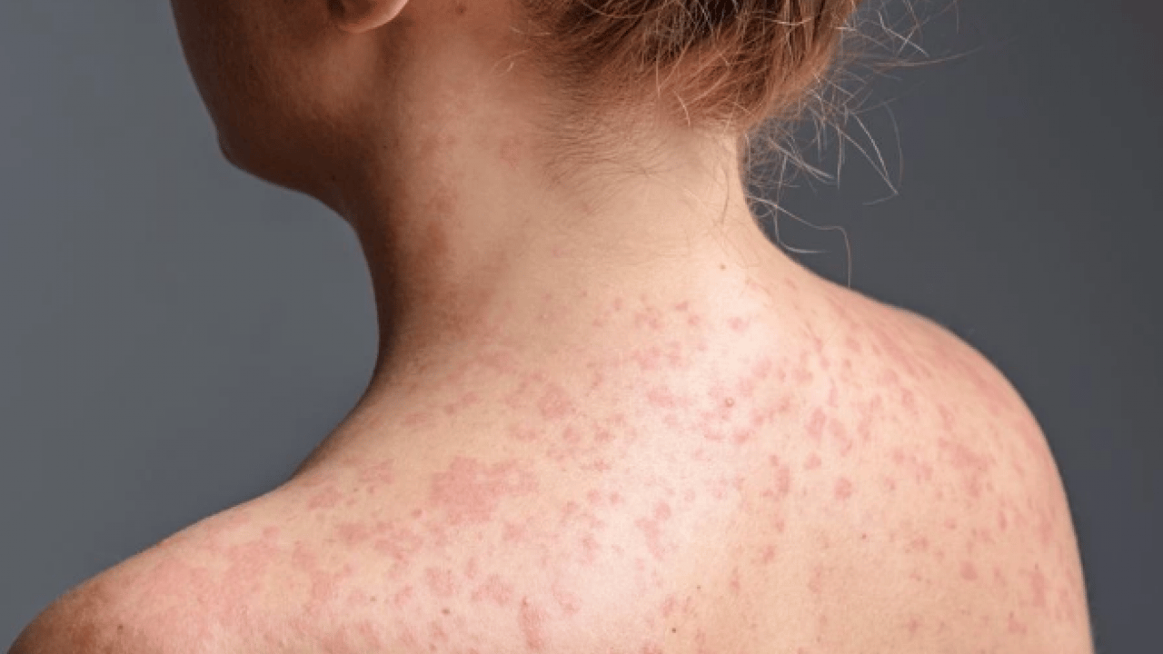 Foto - İstanbul’da korkutan salgın! Vakalar hızla artıyor