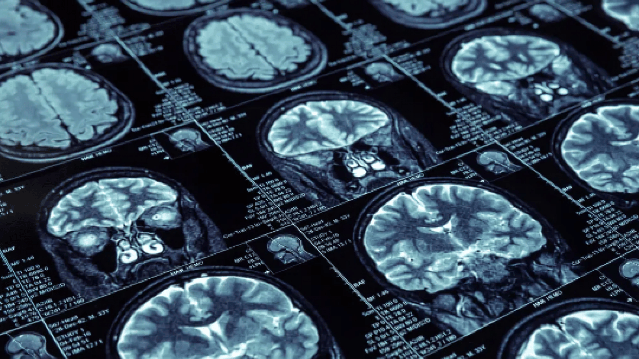 Foto - İşte bu hiç beklenmiyordu: Duygusal hafıza direniyor: Alzheimer'da ribot kanunu