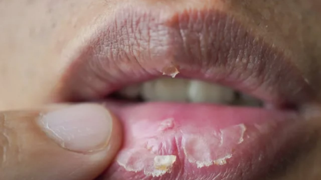 Foto - İşte doğal yöntemlerle bu havalarda korunmanın yolu: Dudak çatlaklıklarına birebir çözüm!