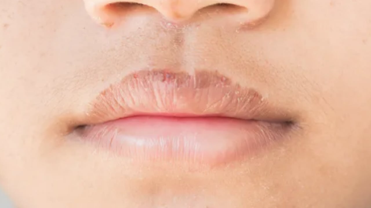 Foto - İşte doğal yöntemlerle bu havalarda korunmanın yolu: Dudak çatlaklıklarına birebir çözüm!