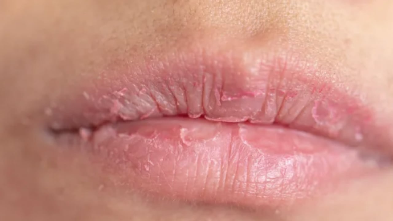 İşte doğal yöntemlerle bu havalarda korunmanın yolu: Dudak çatlaklıklarına birebir çözüm!