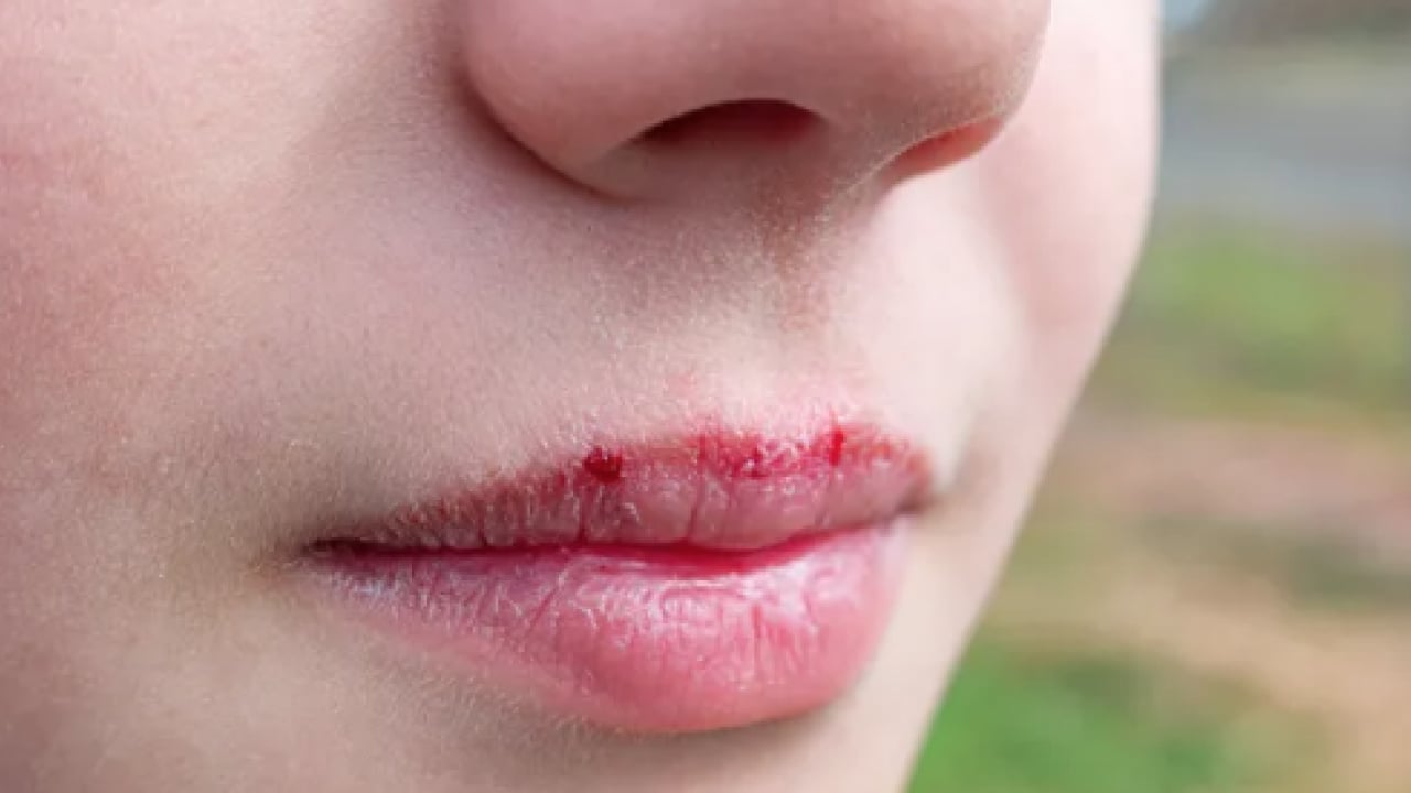 Foto - İşte doğal yöntemlerle bu havalarda korunmanın yolu: Dudak çatlaklıklarına birebir çözüm!