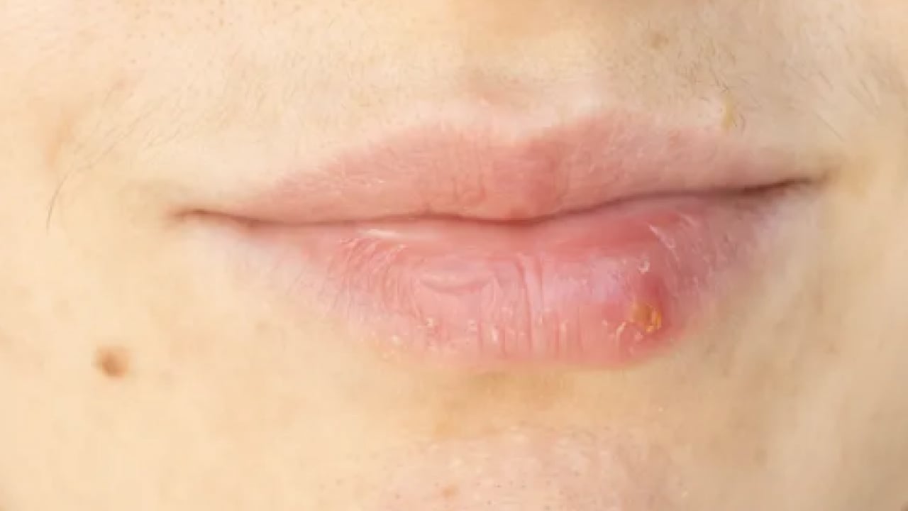 Foto - İşte doğal yöntemlerle bu havalarda korunmanın yolu: Dudak çatlaklıklarına birebir çözüm!
