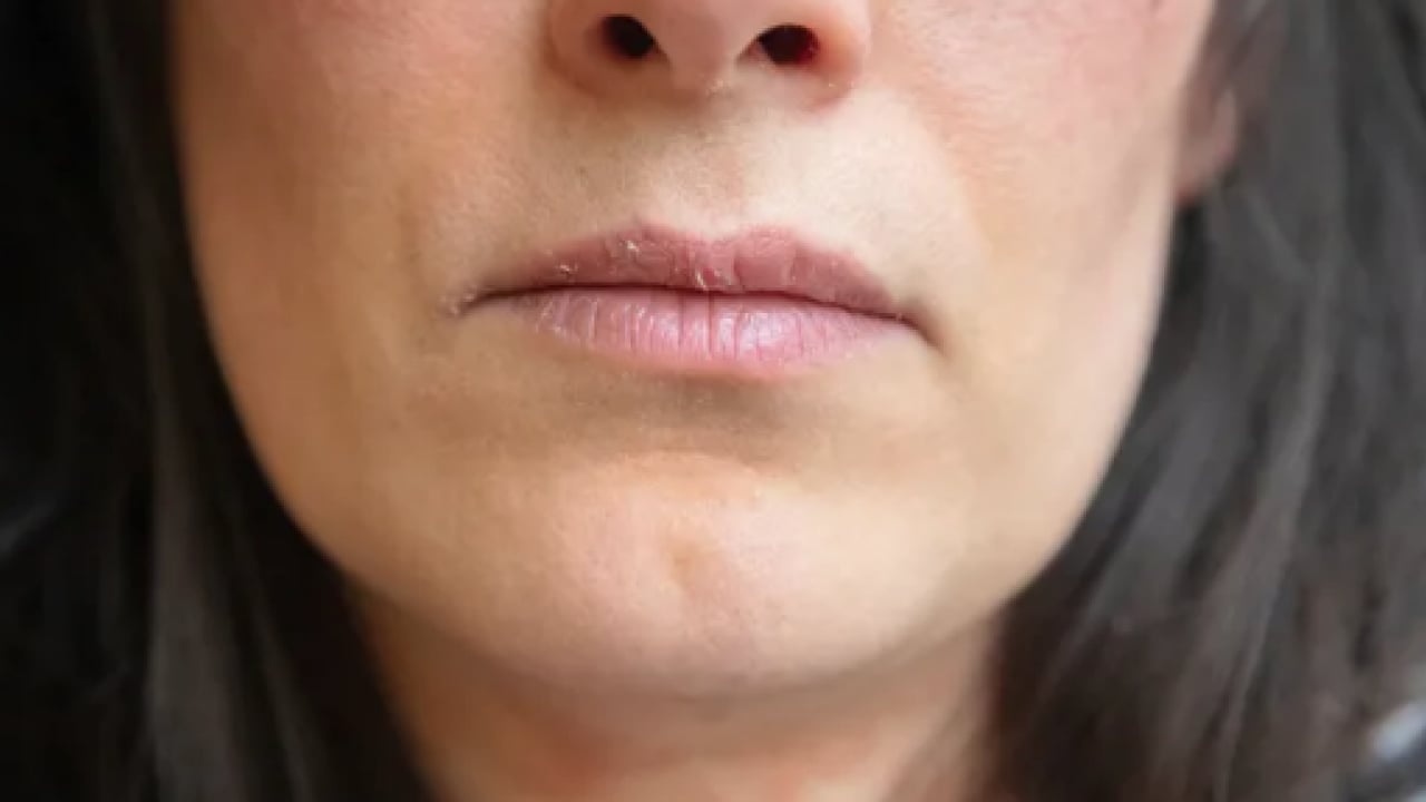 Foto - İşte doğal yöntemlerle bu havalarda korunmanın yolu: Dudak çatlaklıklarına birebir çözüm!