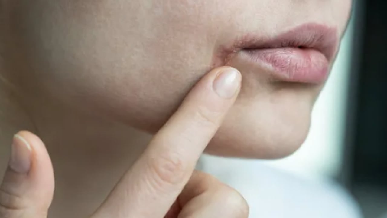 Foto - İşte doğal yöntemlerle bu havalarda korunmanın yolu: Dudak çatlaklıklarına birebir çözüm!