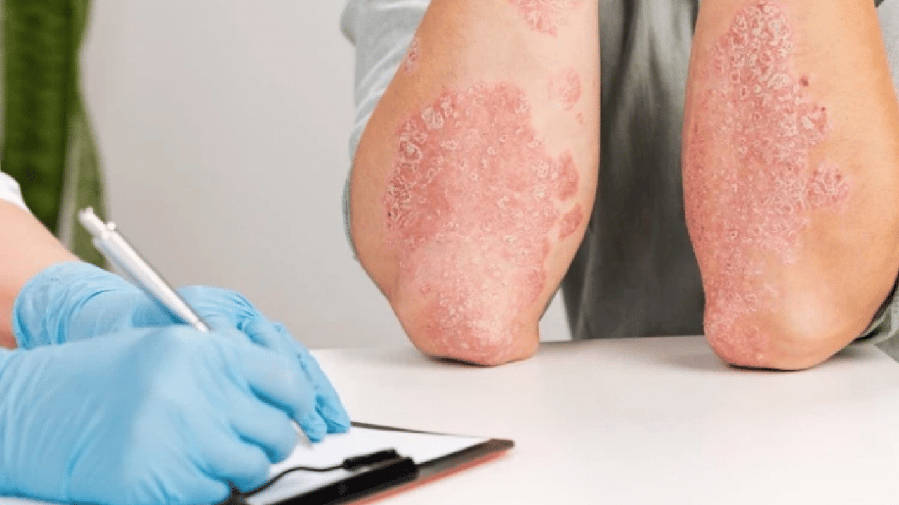 Foto - İşte evde egzama tedavisi için doğal yöntemler ve öneriler...