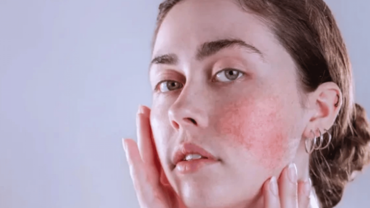 İşte evde egzama tedavisi için doğal yöntemler ve öneriler...