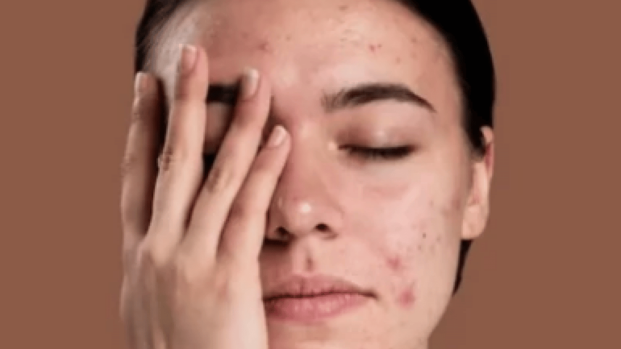 Foto - İşte evde egzama tedavisi için doğal yöntemler ve öneriler...