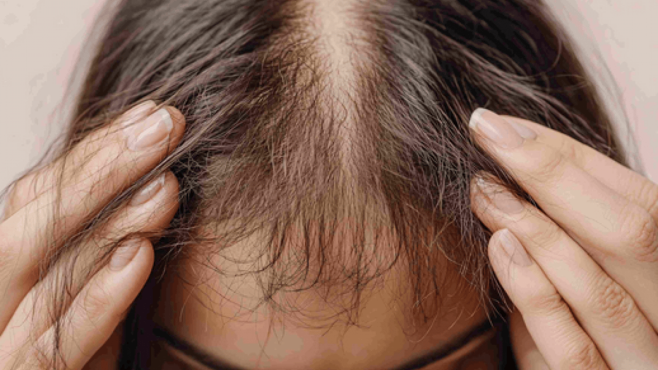 Foto - İşte evde kolayca hazırlanan o yöntem... 1 kaşığı saç dökülmesini durduruyor