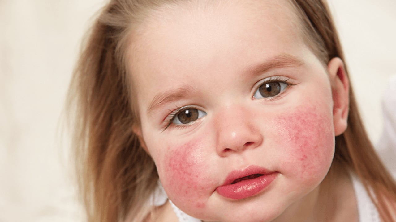 Foto - JAMA'dan dikkat çeken araştırma sonuçları: Her 20 çocuktan birinde 6 yaşına kadar...