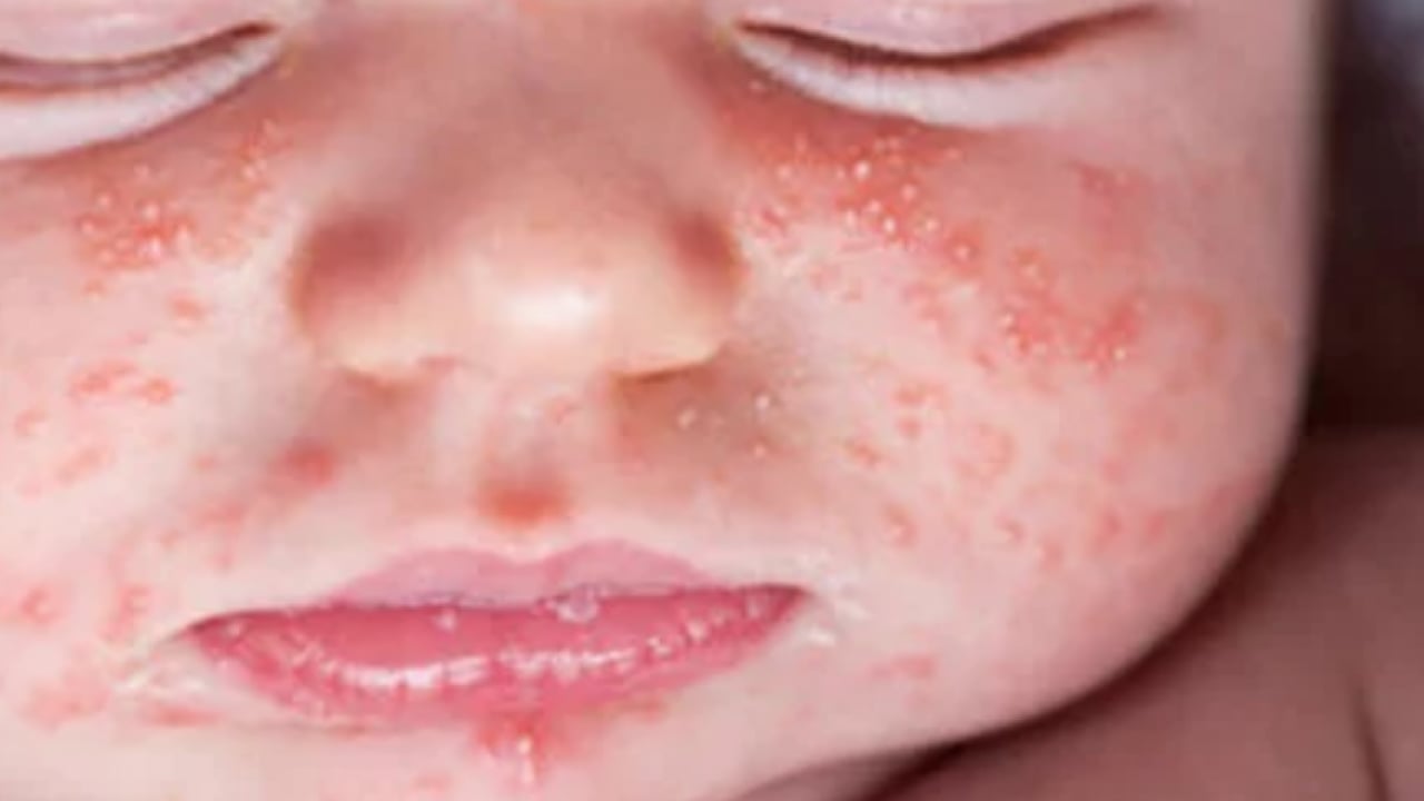 Foto - JAMA'dan dikkat çeken araştırma sonuçları: Her 20 çocuktan birinde 6 yaşına kadar...