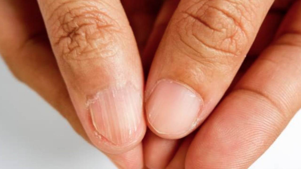 Foto - Demir eksikliği sessizce zamanla yorar! Kadınlarda demir eksikliği belirtileri nelerdir?