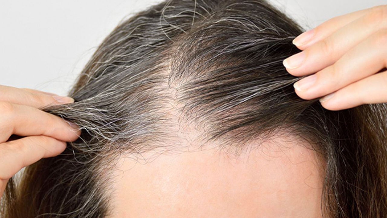 Foto - Kadınlarda saç dökülmesinin gerçek sebebi! Saçınız değil, sağlığınız dökülüyor olabilir