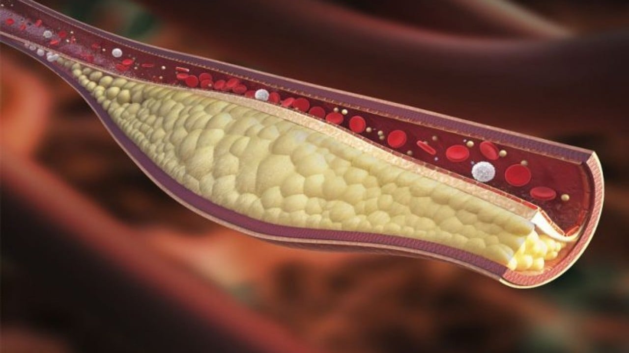 Foto - Kan testinde şaşırtan sonuç: Beklenmedik kolesterol gerçeği ortaya çıktı