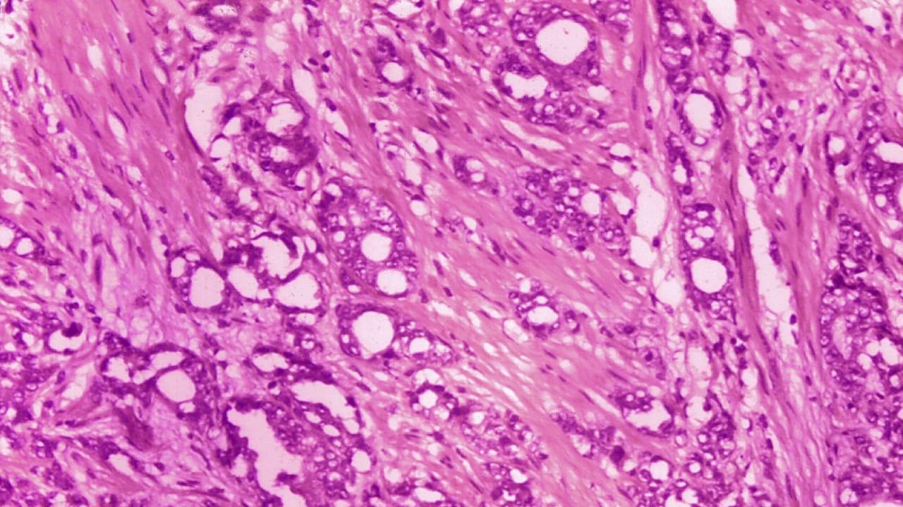 Foto - Kanser için yeni nesil araştırmalar çareyi buldu: İlaç prostat kanseriyle mücadele ediyor! Hayrete düşürdü